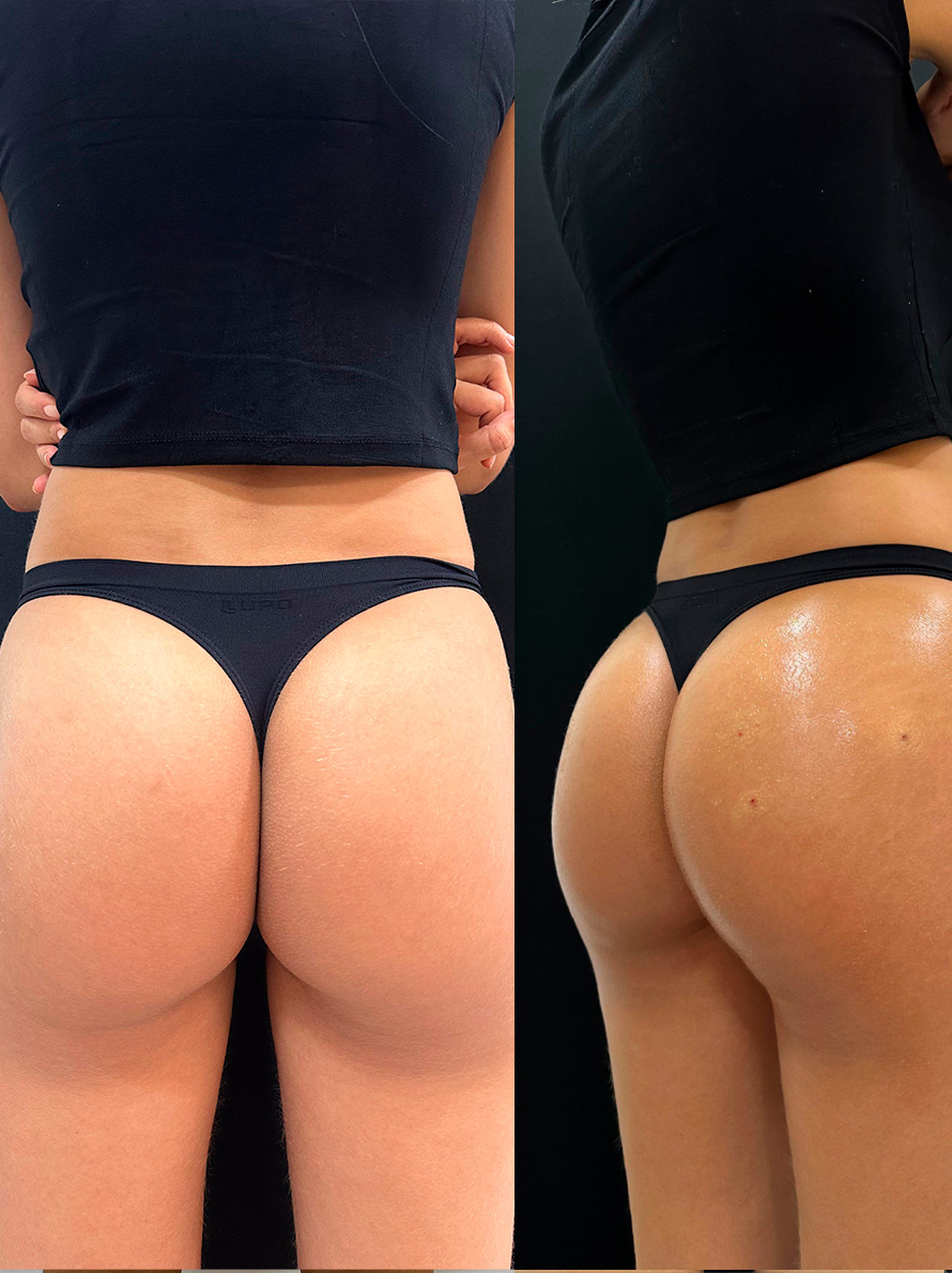 ANTES 4